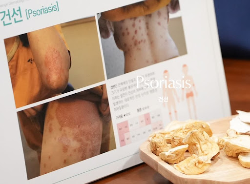 생기한의원 건선 페이지에서 정리한 건선 종류별 피부 모습